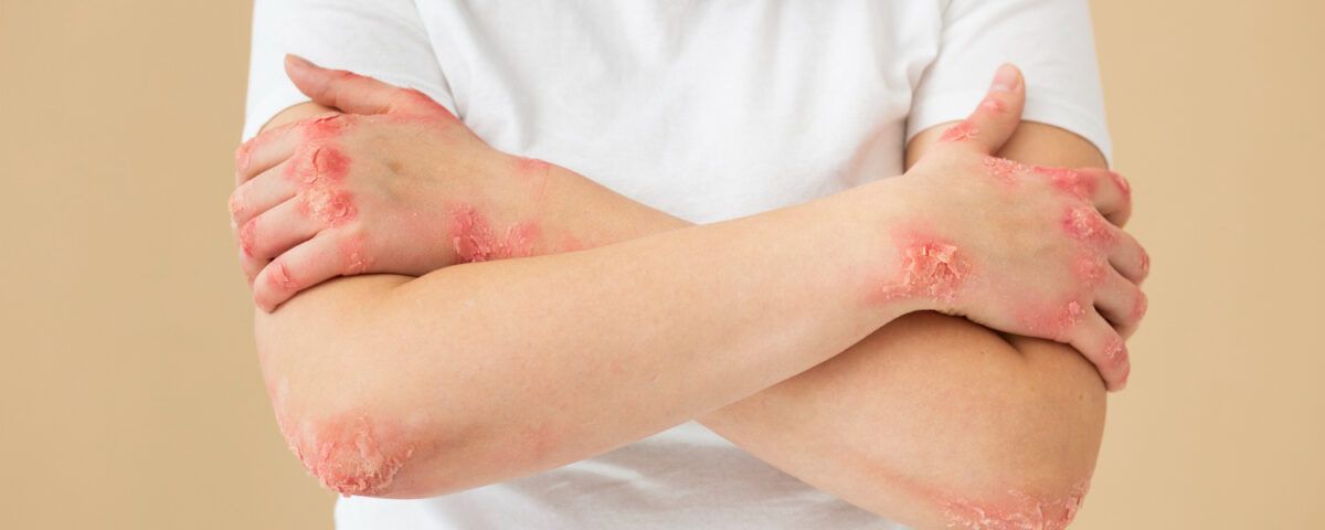 dermatita-seboreica-tratament-naturist