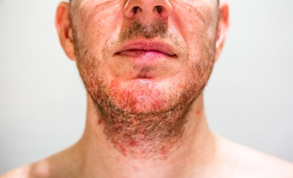 dermatita-seboreica-tratament-naturist-ce-este