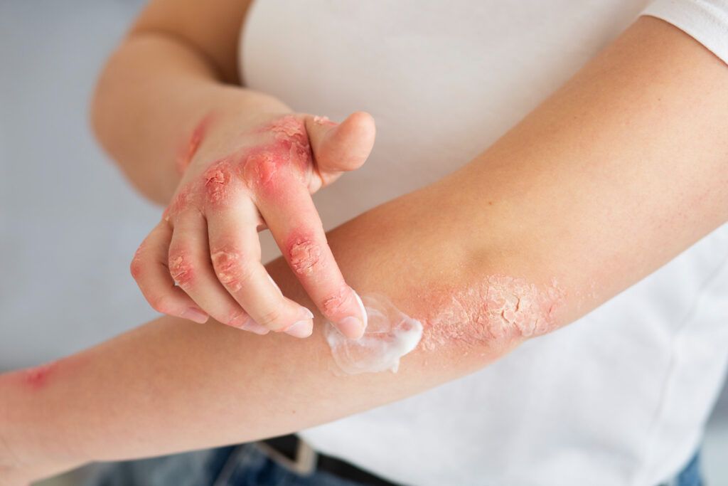 dermatita-seboreica-tratament-naturist-tipuri